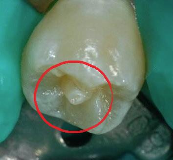 男童牙齿长在牙龈上,男童牙齿内壁长了一颗牙