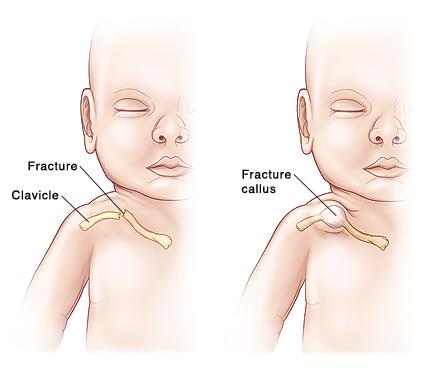新生儿锁骨骨折是谁的责任,新生儿锁骨骨折是怎么造成的