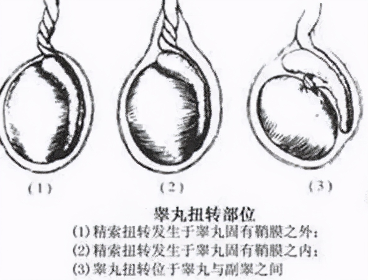 蛋蛋的忧伤！男孩*体下**疼痛被误当感冒，错过黄金救治时间