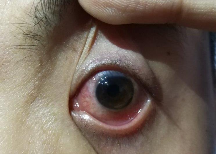 慢性卡他性结膜炎是什么结膜炎,春季卡他性结膜炎最新治疗方法