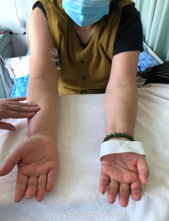 留置picc需要什么医嘱,picc静脉置管能随时拔除