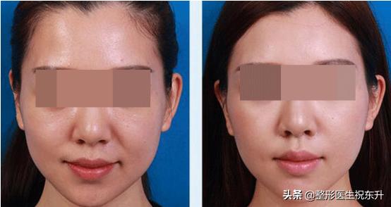 30岁皮肤松弛法令纹重怎么办,30多岁长了法令纹怎么办