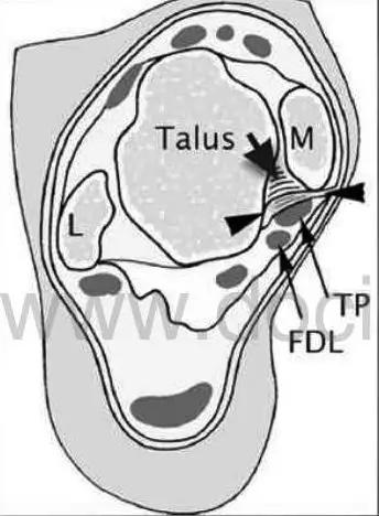 踝关节撞击症问诊,踝关节撞击综合征的x线表现
