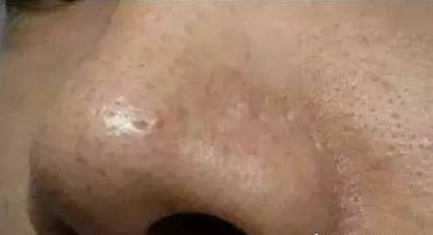 男性背后长疙瘩红红的是什么原因,背后和胸前长红点是什么原因