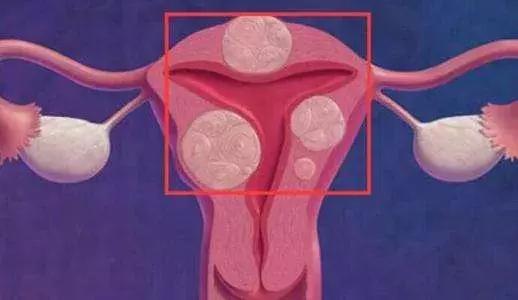 有什么中药能治子宫多发性肌瘤,什么中草药对子宫肌瘤有作用