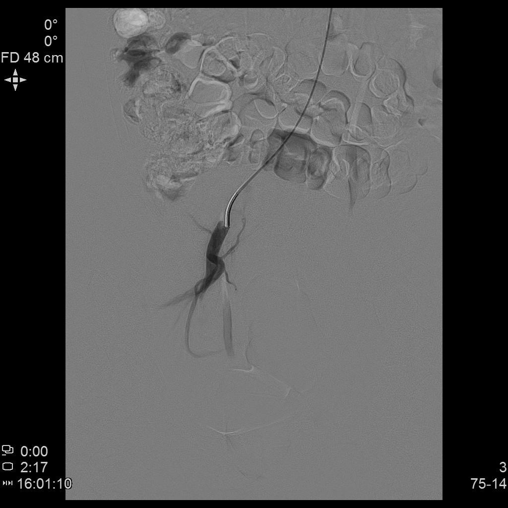 从手腕处做子宫动脉栓塞手术,子宫肌瘤做动脉穿刺有危险吗