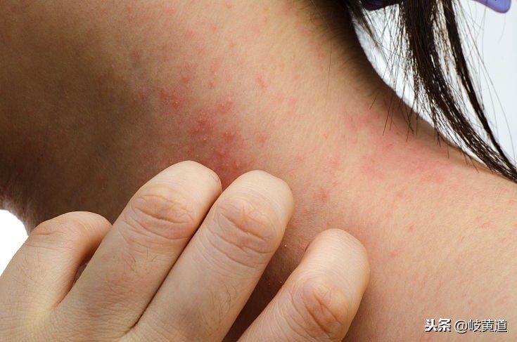 湿疹反反复复能不能完全治好,湿疹反复发作应注意四点