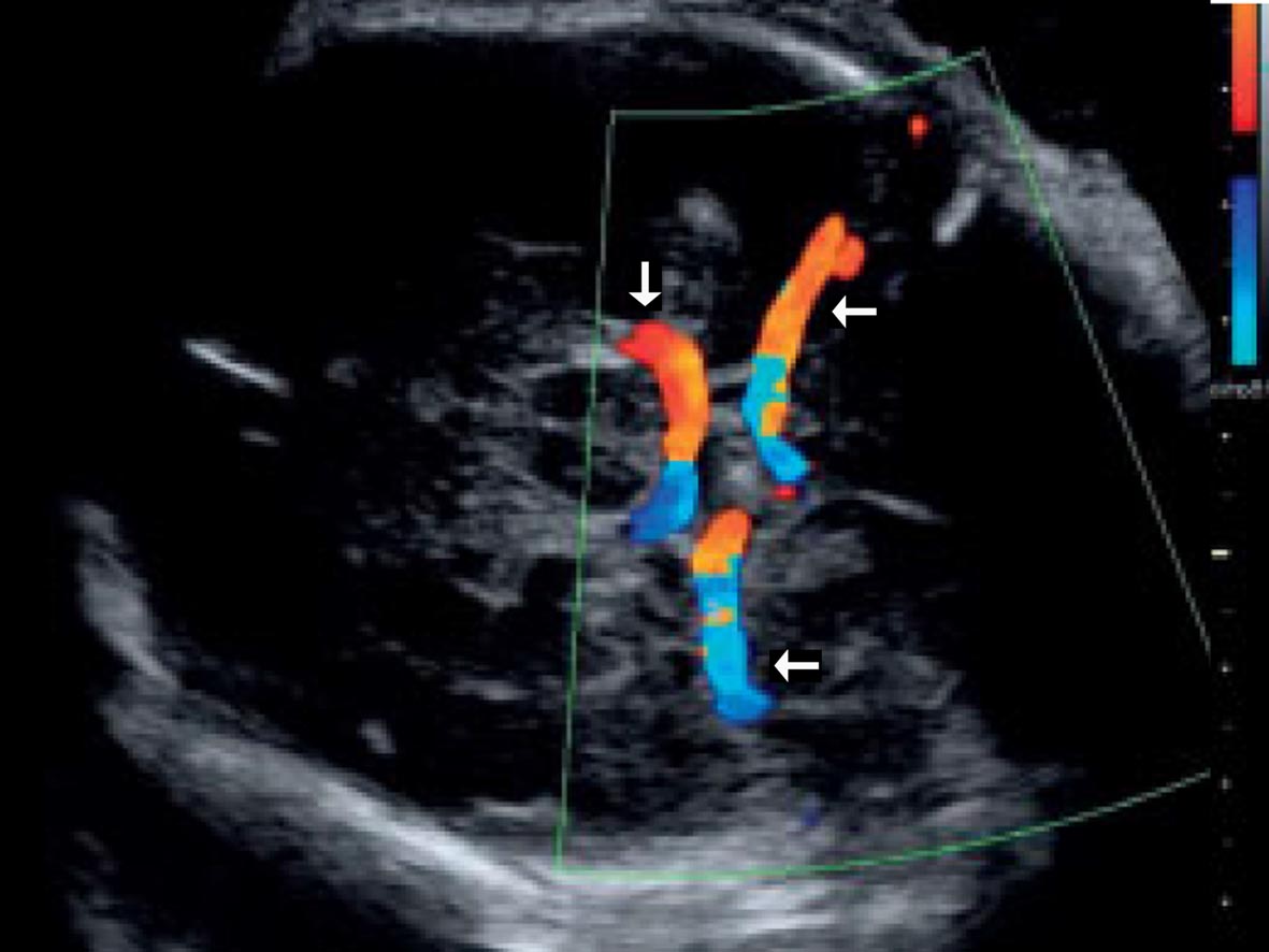 孕期头部彩超查什么,孕期检查胎儿头部有一个地方宽