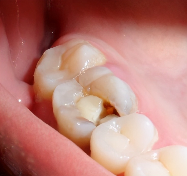 门牙根管治疗后没做牙冠牙齿劈裂,牙齿残冠一定要做根管治疗吗