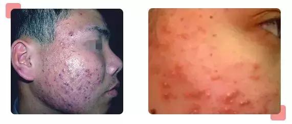 带状疱疹和荨麻疹的治疗区别,受慢性荨麻疹困扰怎么治疗