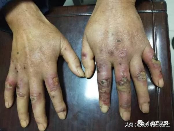 冻疮后期接触水干燥发痒怎么治,冻伤痒痛