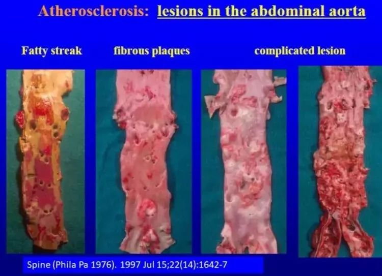 腰椎间盘突出坐骨神经痛如何缓解,腰椎间盘突出脚痛神经痛怎么缓解