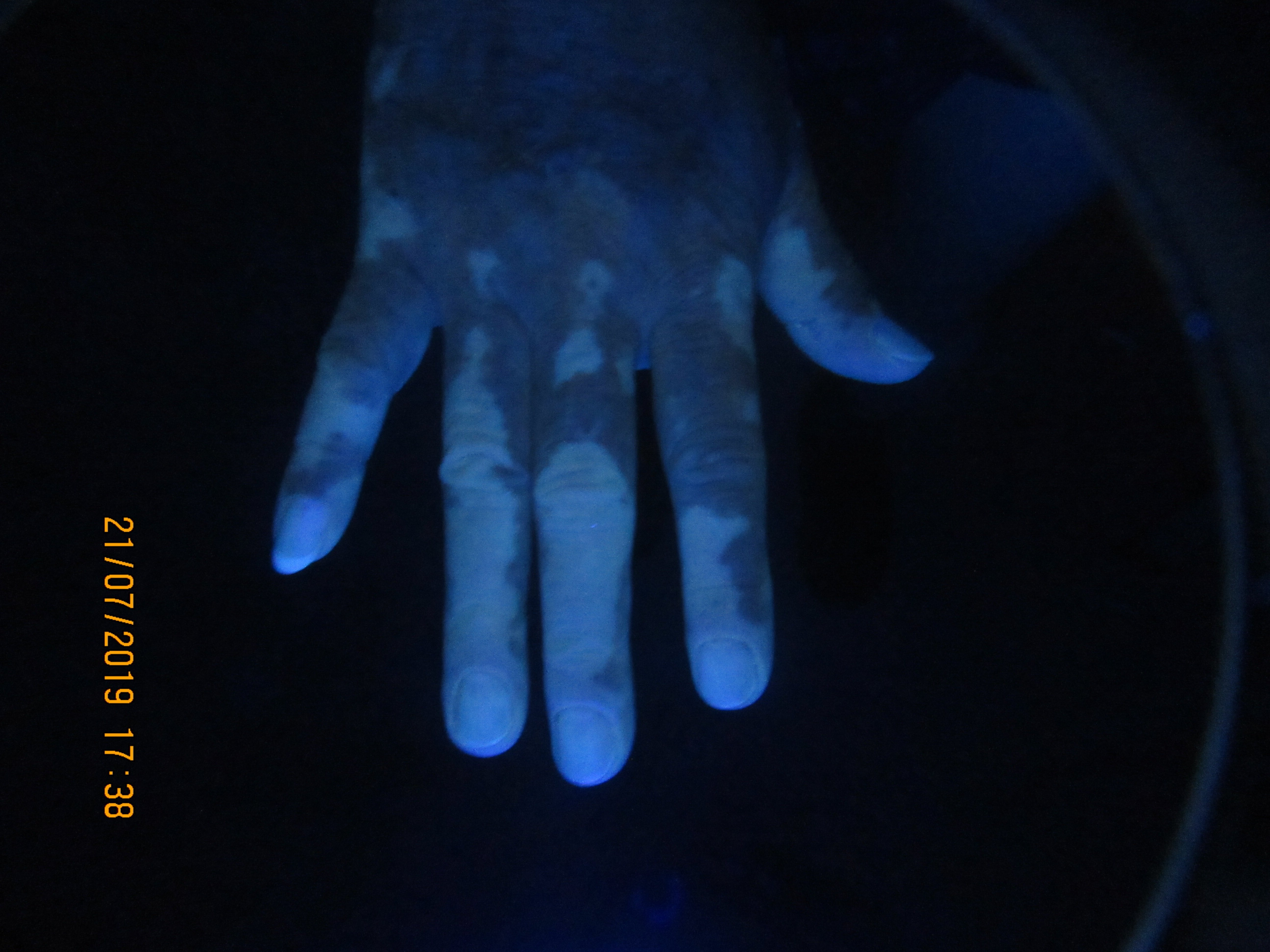 肢端型白癜风最佳治疗方案,肢端型白癜风怎么治疗