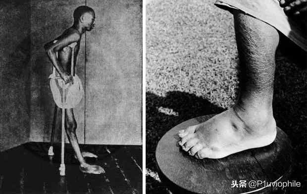 日本脚气病历史,为什么日本大多数死于脚气