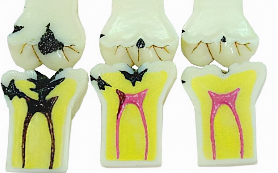 根管治疗后，牙齿还能用多久？听良心牙医讲解