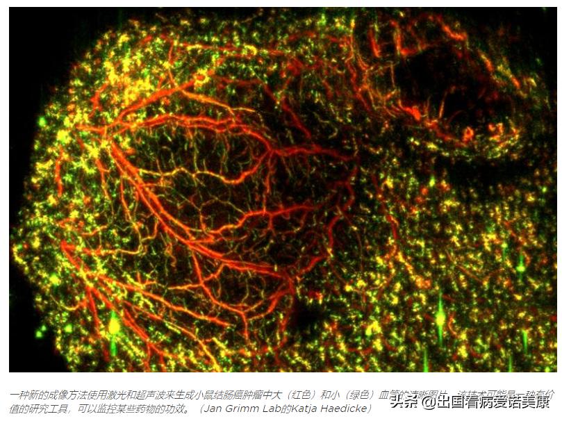 美国癌症新科技：激光超声成像，肿瘤从此无处可逃