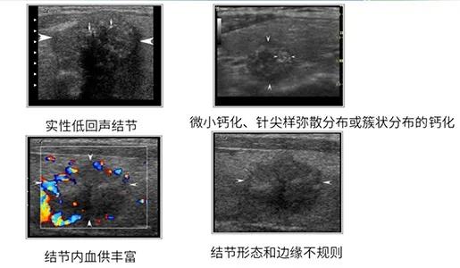甲状腺彩超结节无包膜是什么意思,甲状腺结节有几个低回声代表什么