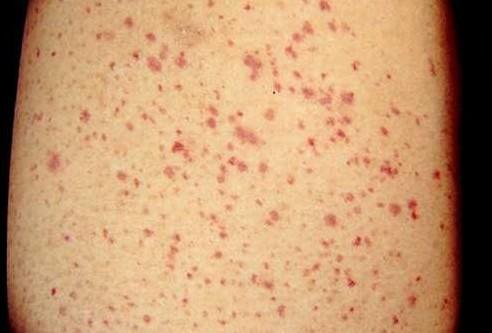 过敏性紫癜肾炎饮食上注意什么,吸入性的过敏性紫癜要注意什么