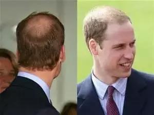 养护头发小窍门有哪些呢,如何养护头发毛囊