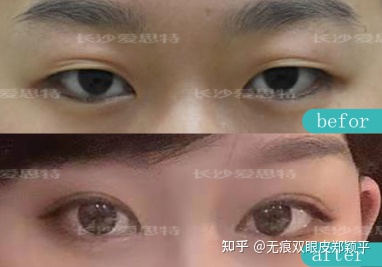 可以只开眼角不割双眼皮吗,双眼皮到底要不要开眼角