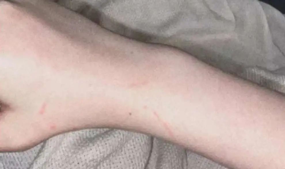 被流浪猫咬了24小时有什么事,被感染新冠的猫咬了一口