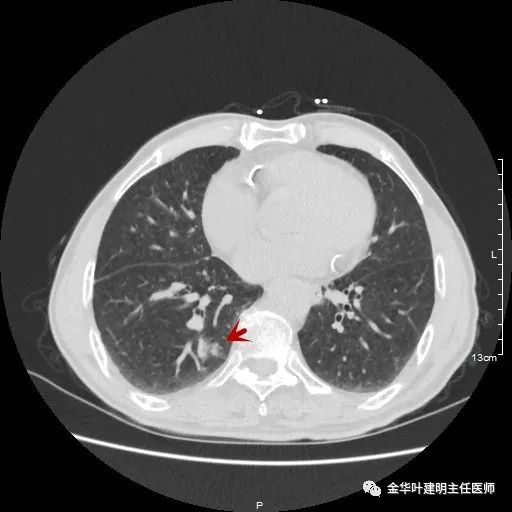 多发原发肺癌能根治吗,肺部原发性恶性肿瘤好治