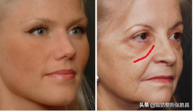 印第安纹部位出现皱纹,印第安皱纹怎么去除