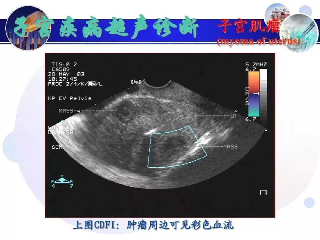 纯干货！子宫及附件解剖和超声诊断