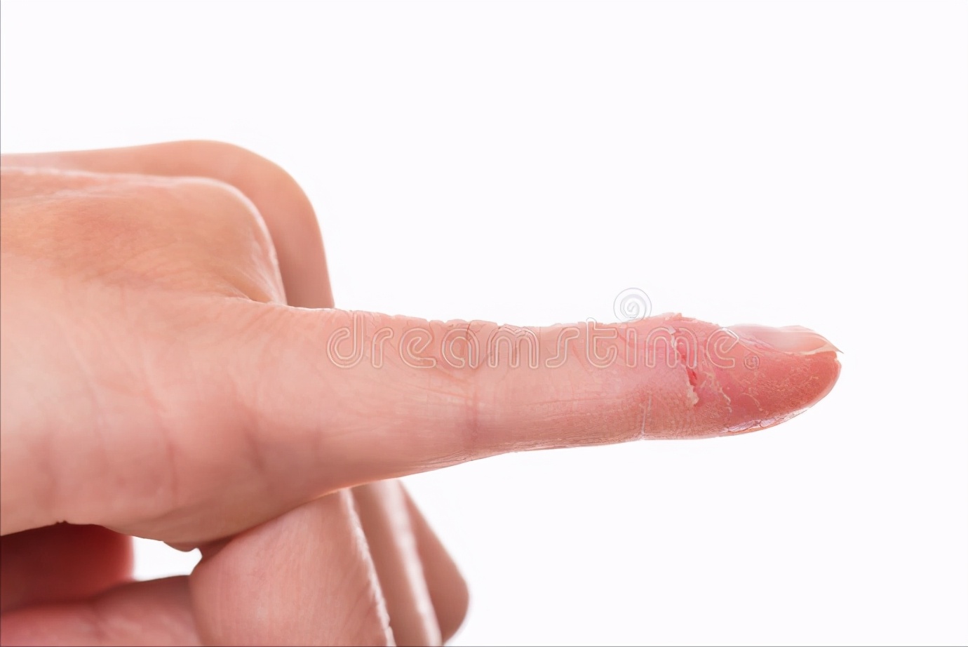 甲沟炎的倒刺要不要剪掉,手上的倒刺不长拔会得甲沟炎吗