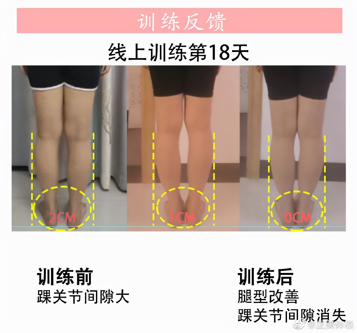 老年o型腿最快变直的方法,o型腿适合穿什么类型鞋