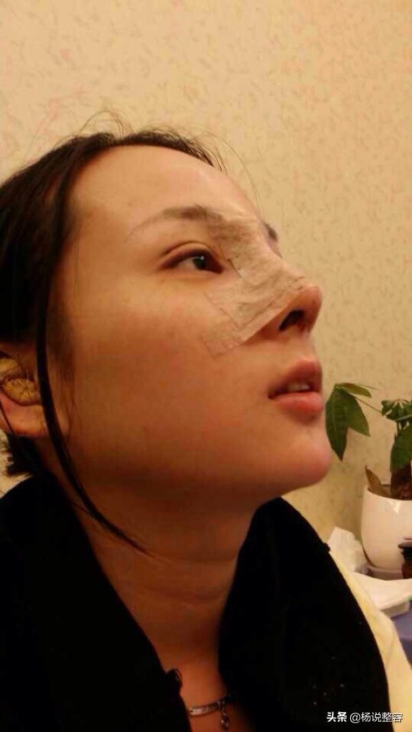 隆鼻失败修复的几点建议,隆鼻失败医生会马上为患者修复吗