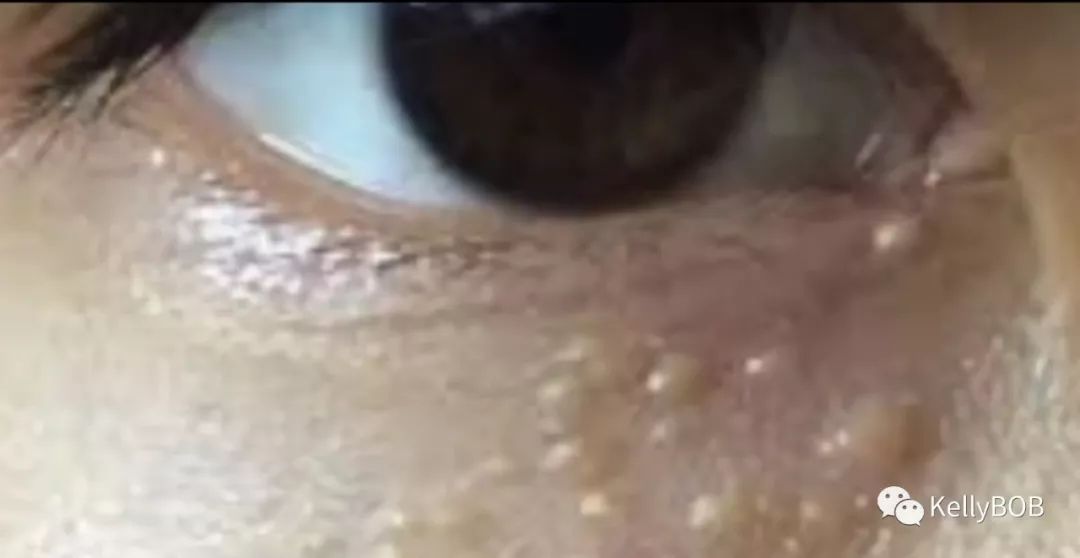 告别脂肪粒秘籍,去眼部脂肪粒最有效的方法