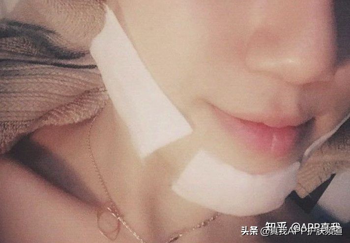 痘痘应该等它自己爆还是挤掉,长痘痘了要等它自己破掉吗