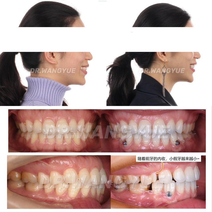 上海舌侧正畸医生,上海舌侧矫正哪家好