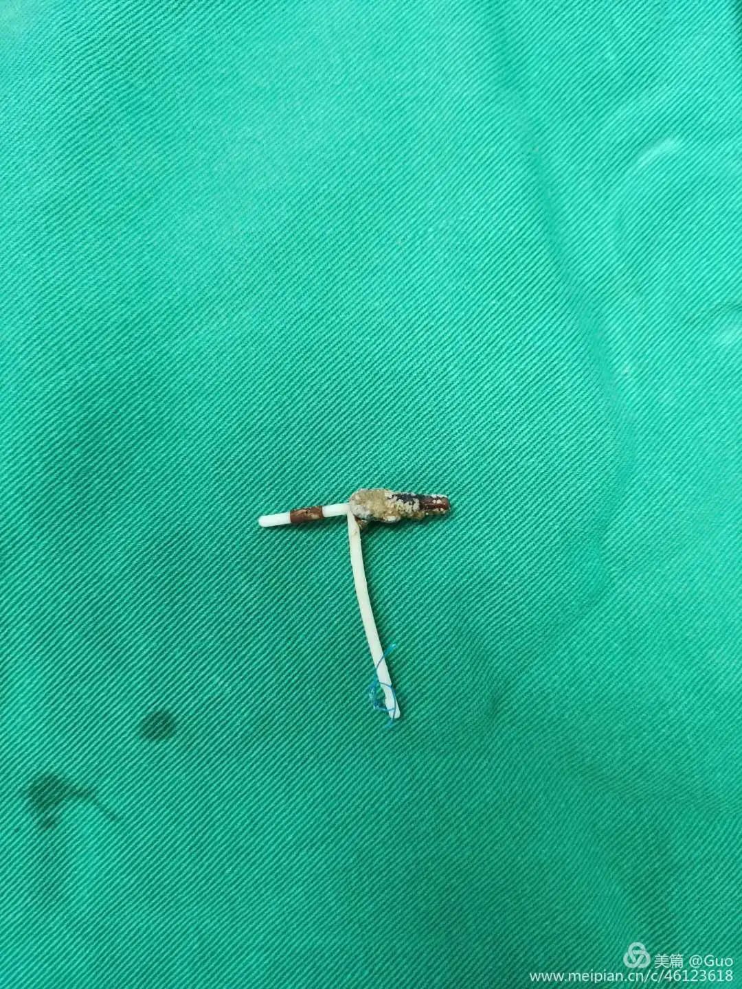 摘除节育环手术,节育环的摘除手术