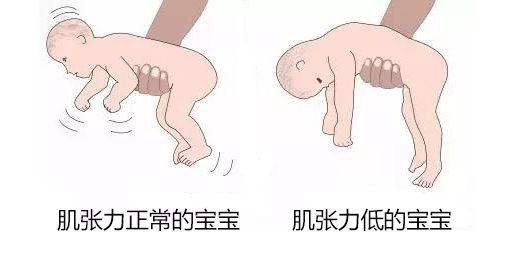 怎么判断宝宝肌张力是不是正常,医生怎么给宝宝肌张力评估