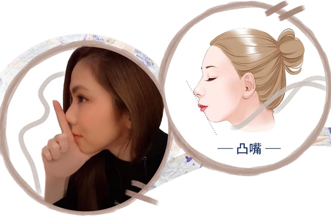 被脸型拖累的颜值,被嘴凸影响的颜值