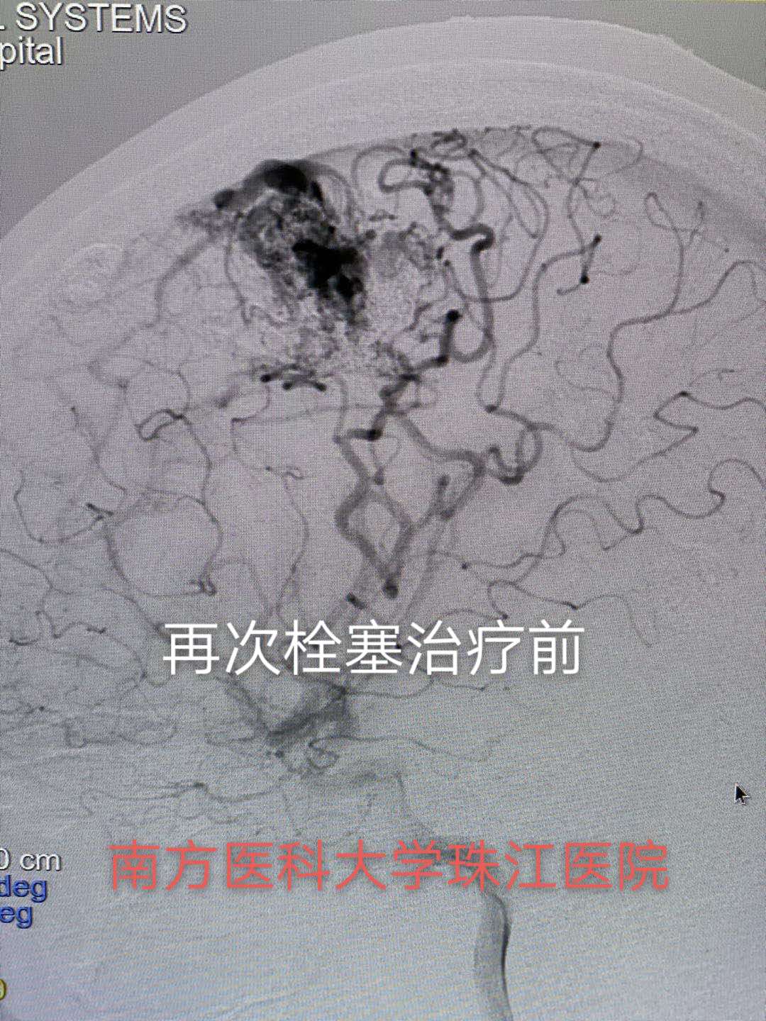 脑动静脉畸形可选用的栓塞物,脑动静脉畸形做伽玛刀后康复