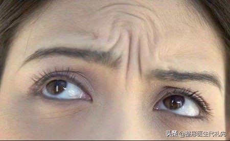 提眉过程中会不会川字纹加重,提眉术可以改善川字纹吗