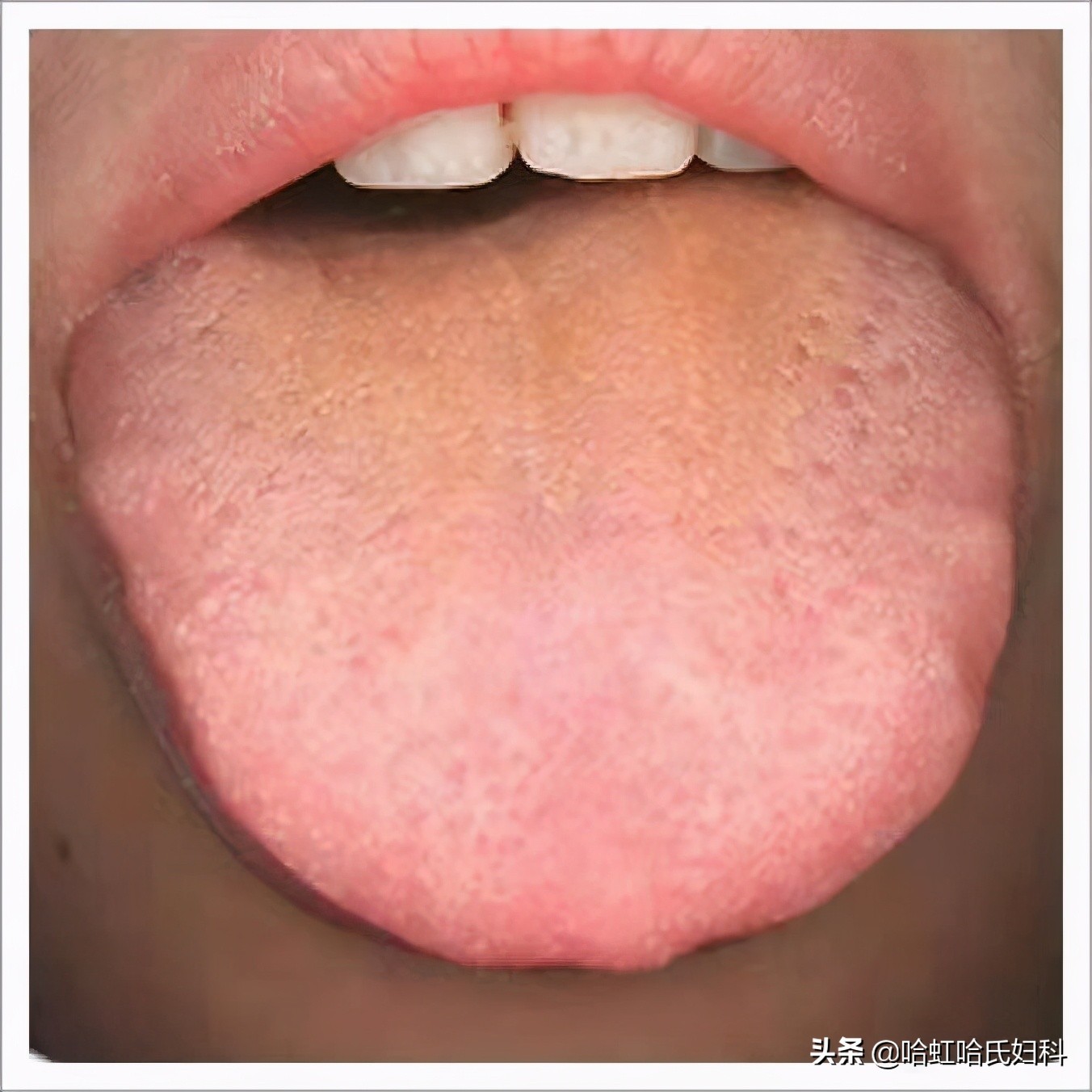 中医的五种方式告诉你是否脾虚,一招教您判断体内湿气