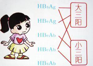 乙肝五项245阳性会传染吗,乙肝五项245阳性用治疗吗