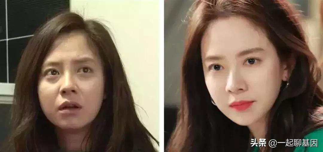 大眼袋眼纹抹平了,眼纹医美怎么去除