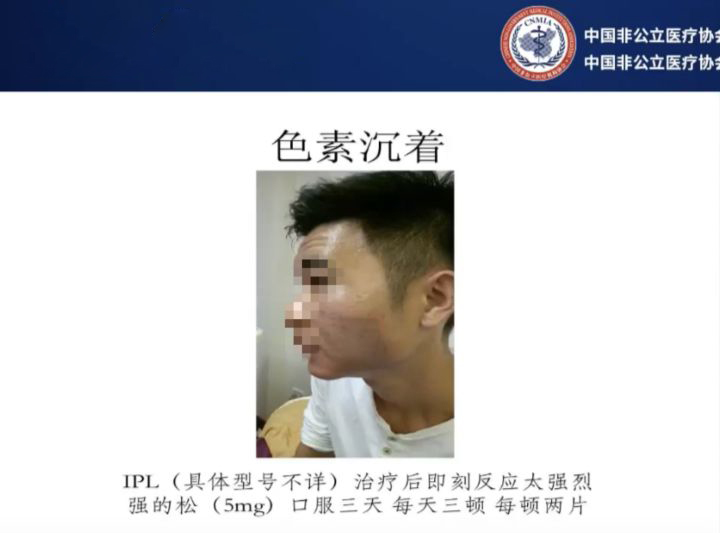 打完玻尿酸和瘦脸针的注意事项,打完玻尿酸和瘦脸针应该注意什么