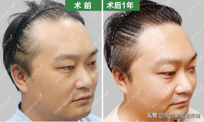 梅艳芳癌症为啥治不好,梅艳芳头发掉光