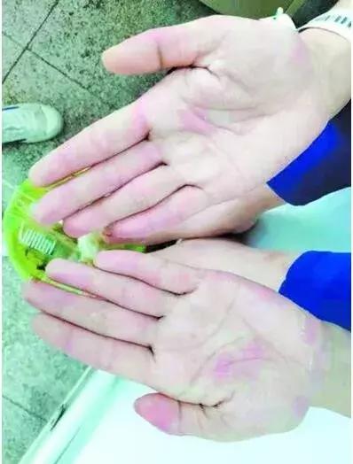 19岁女孩天天吃鱼,竟导致手脚“满目疮痍”!