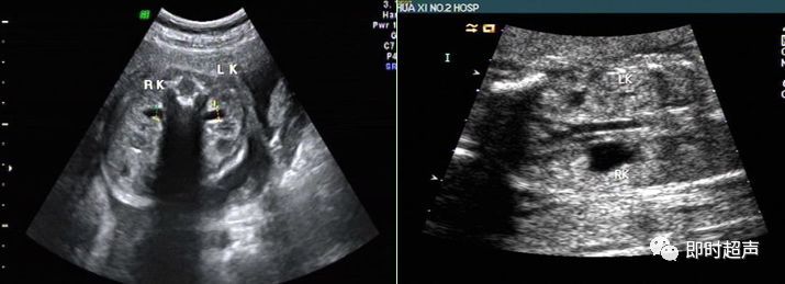 产科常规彩色超声报告单介绍,常见妇科疾病超声报告