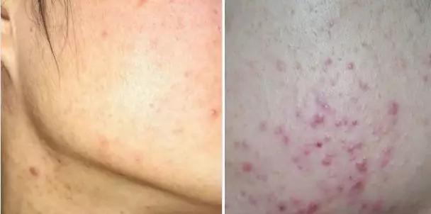 说说都如何治好痘痘的,一痘毁所有5个祛痘小技巧