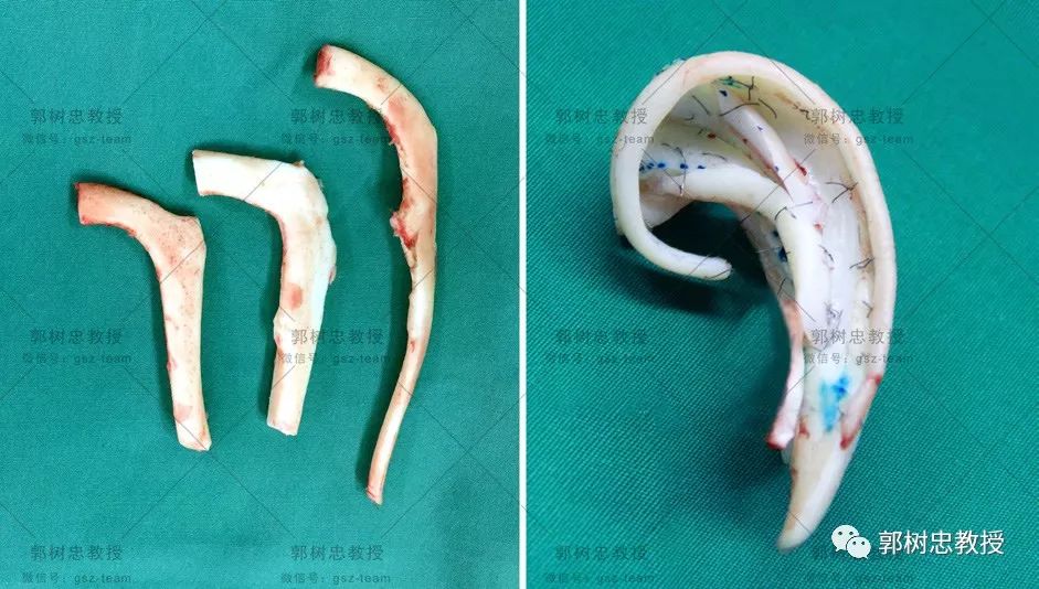 小耳畸形那些事儿（三十）让再造的耳朵陪你一辈子