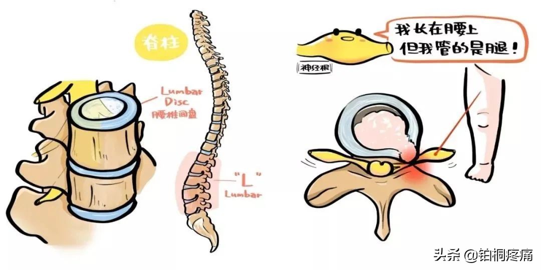 腰椎间盘突出腰不疼腿疼怎么回事,腰椎突出压迫神经腿疼睡觉姿势图