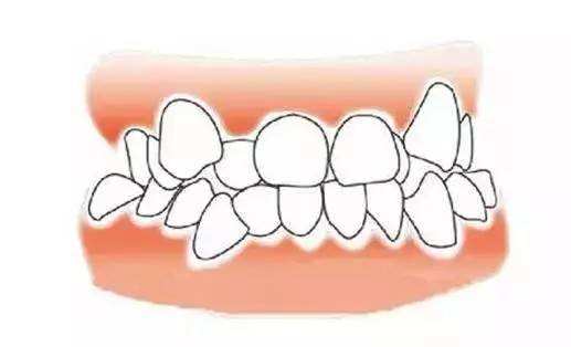 牙齿严重黑三角怎么补救,牙齿出现黑三角能矫正吗